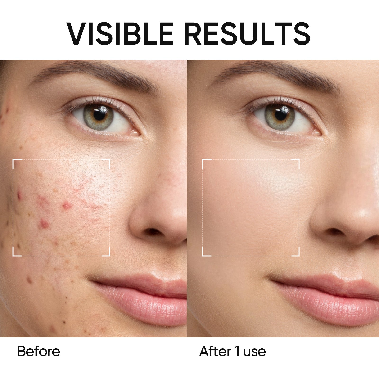 Stick Purifiant Anti-Acné à l’Armoise (Mugwort)