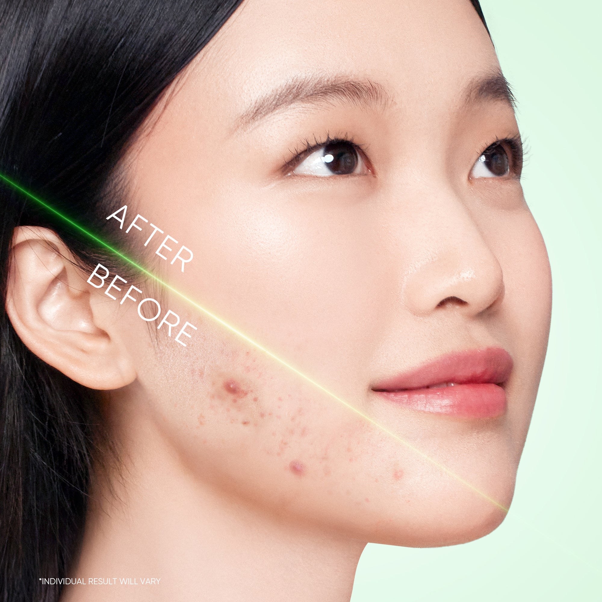 Gel Nettoyant Anti-Acné 3X Acides