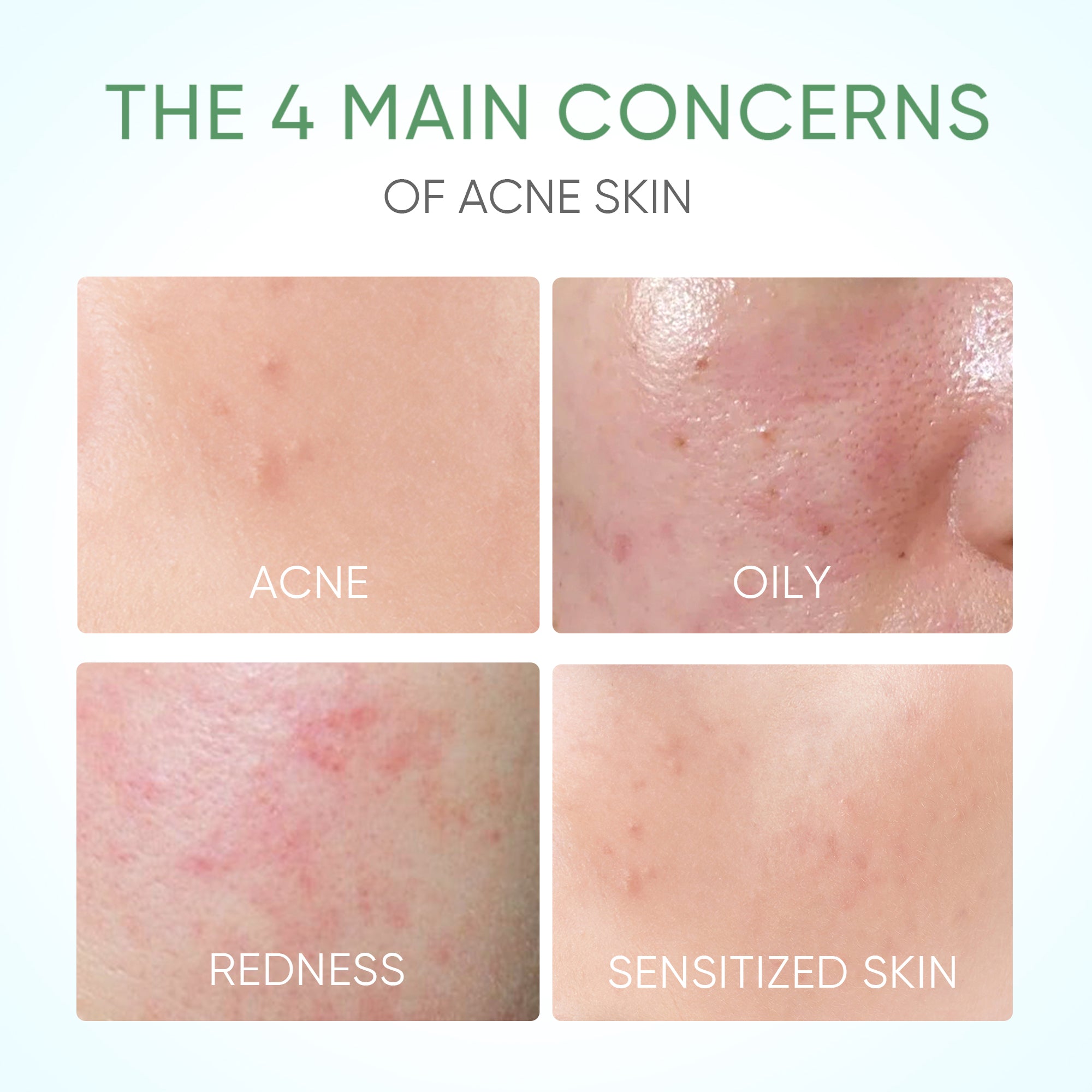 Tonique Apaisant Acné Centella Pure 80ml pour Peaux Sensibles et à Tendance Acnéique